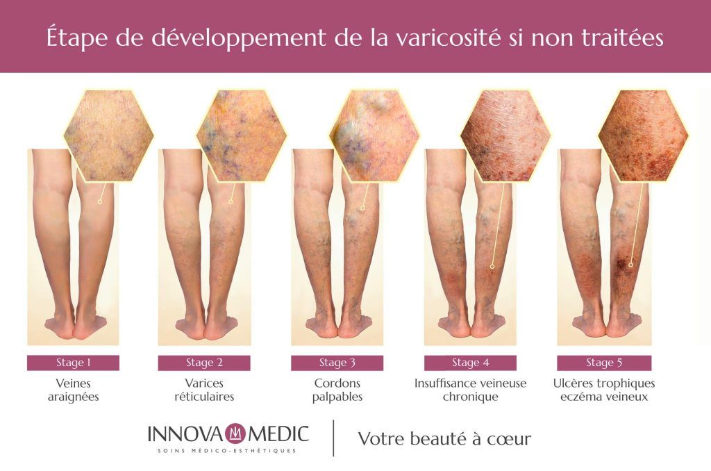 Traitement Des Varices Innova Medic Votre Beaut Coeur